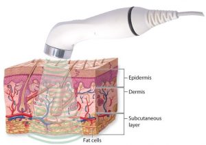 Ultrasound Therapy for Wound Healing - Johari Digital