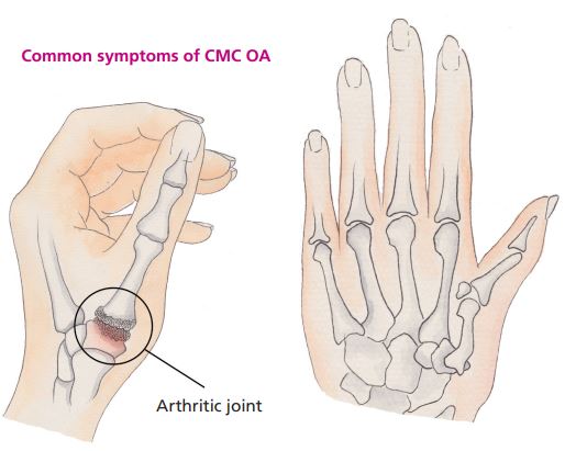 https://www.joharidigital.com/wp-content/uploads/2019/09/Arthritic-joint-Johari.jpg